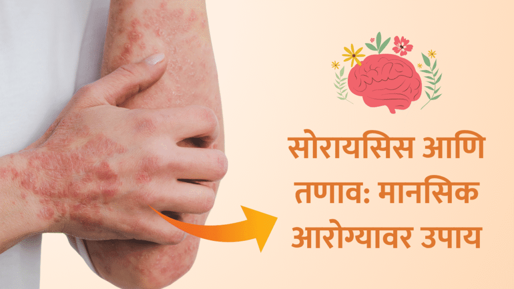 ताणतणावामुळे वाढतो सोरायसिसचा आजार 1 Psoriasis and stress marathi