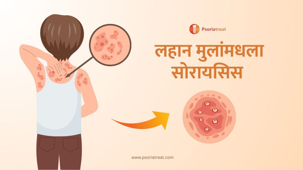 लहान मुलांमधला सोरायसिस