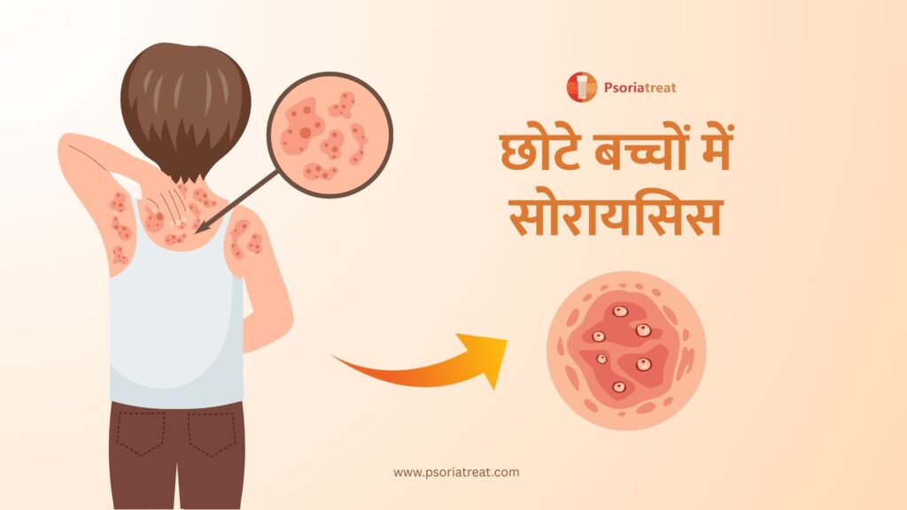 बच्चों में सोरायसिस - Psoriasis in Children in Hindi 1 छोटे बच्चों में सोरायसिस