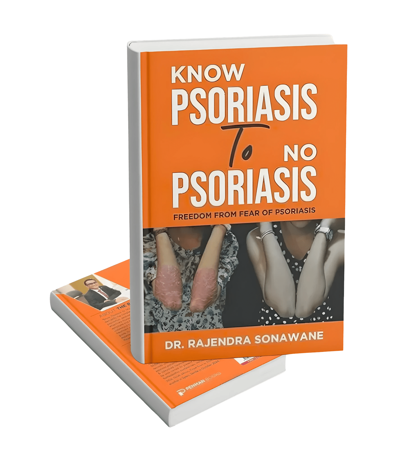 Know Psoriasis to no Psoriasis