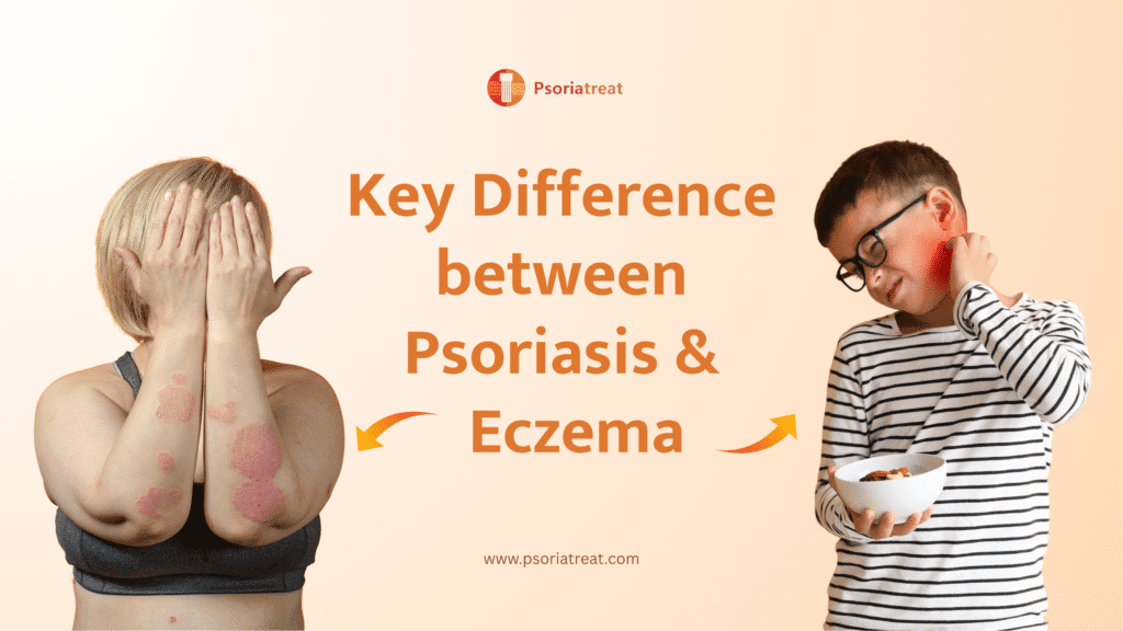 Key difference between Psoriasis and Eczema 1 Key difference between Psoriasis and Eczema