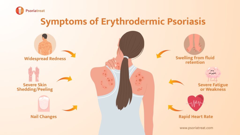 Erythrodermic Psoriasis 1