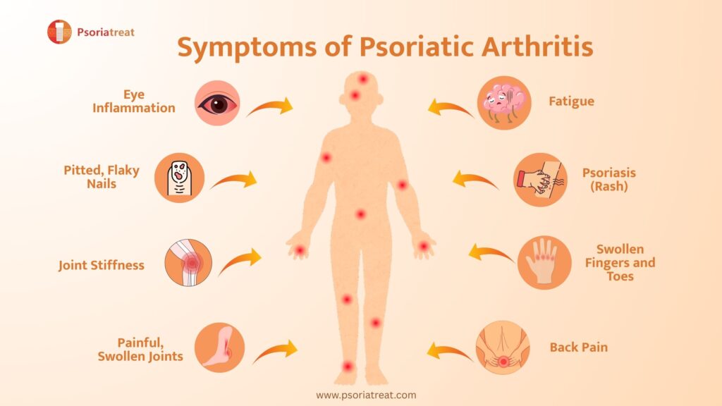 Psoriatic Arthritis - Symptoms, Treatment, Diagnosis 1 Psoriatic Arthritis - Symptoms, Treatment, Diagnosis 1