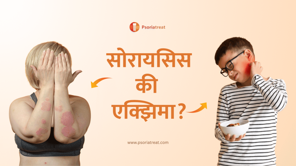 सोरायसिस की एक्झिमा? - Key difference between Psoriasis and Eczema in Marathi 1 सोरायसिस की एक्झिमा?