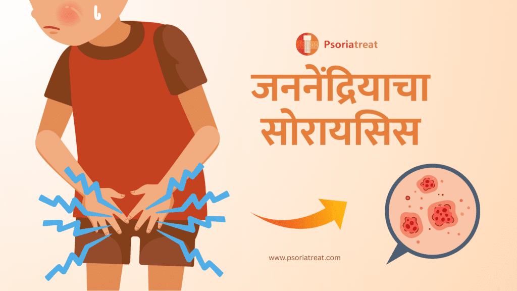 जननेंद्रियाचा सोरायसिस म्हणजे काय, त्याची लक्षणे आणि उपचार काय आहेत? 