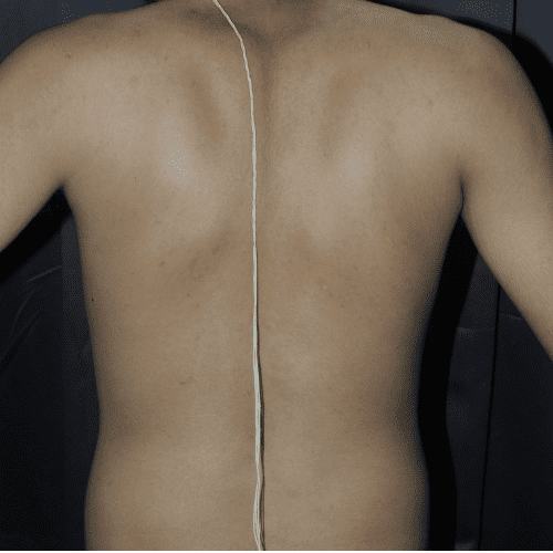 Guttate Psoriasis - Back - After