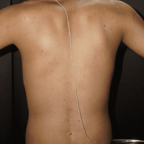 Guttate Psoriasis - Back - Before