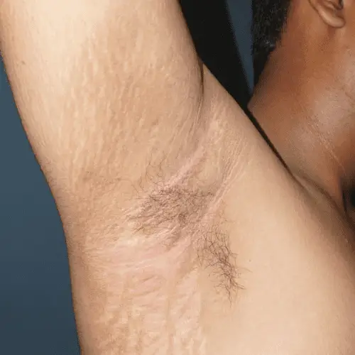 Inverse Psoriasis - Axilla - After