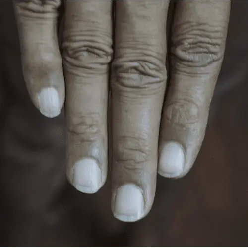 Nail Psoriasis - After