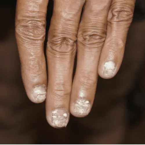 Nail Psoriasis – Before Nail Psoriasis - Before