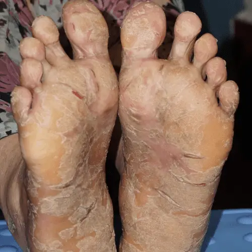 Palmoplantar Psoriasis - Before