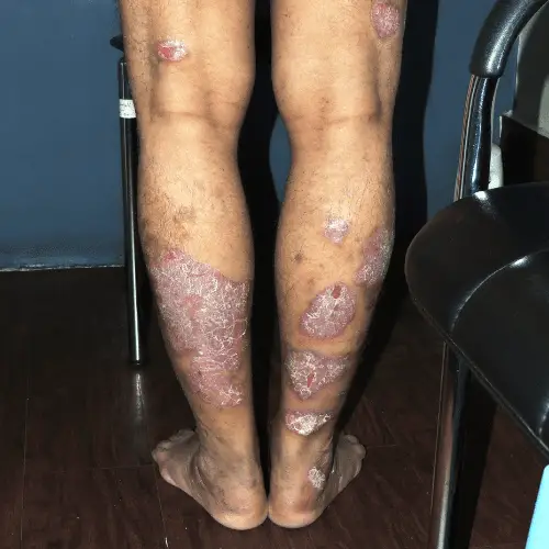 Plaque Psoriasis - Before