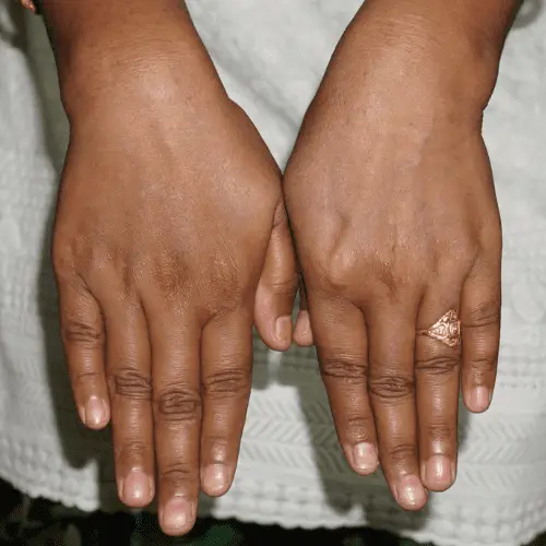 Pustular Psoriasis - After