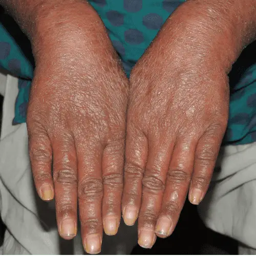 Pustular Psoriasis - Before
