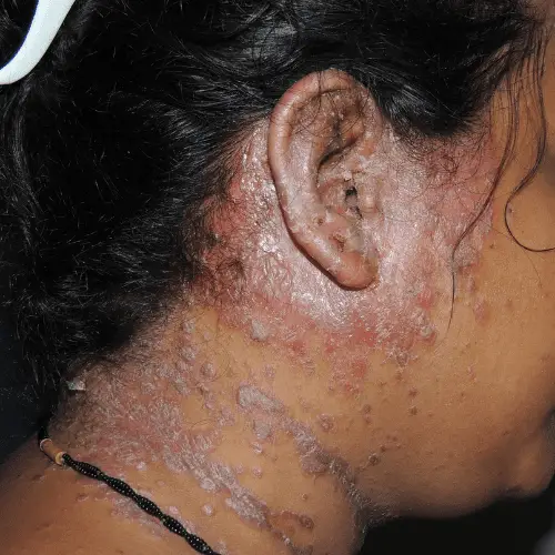 Pustular Psoriasis – before Pustular Psoriasis - before