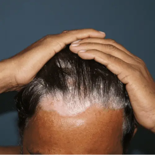 Scalp Psoriasis - Before