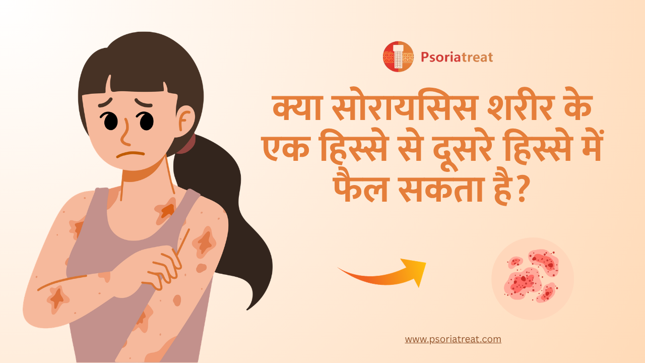 Can psoriasis spread from one body part to another in hindi