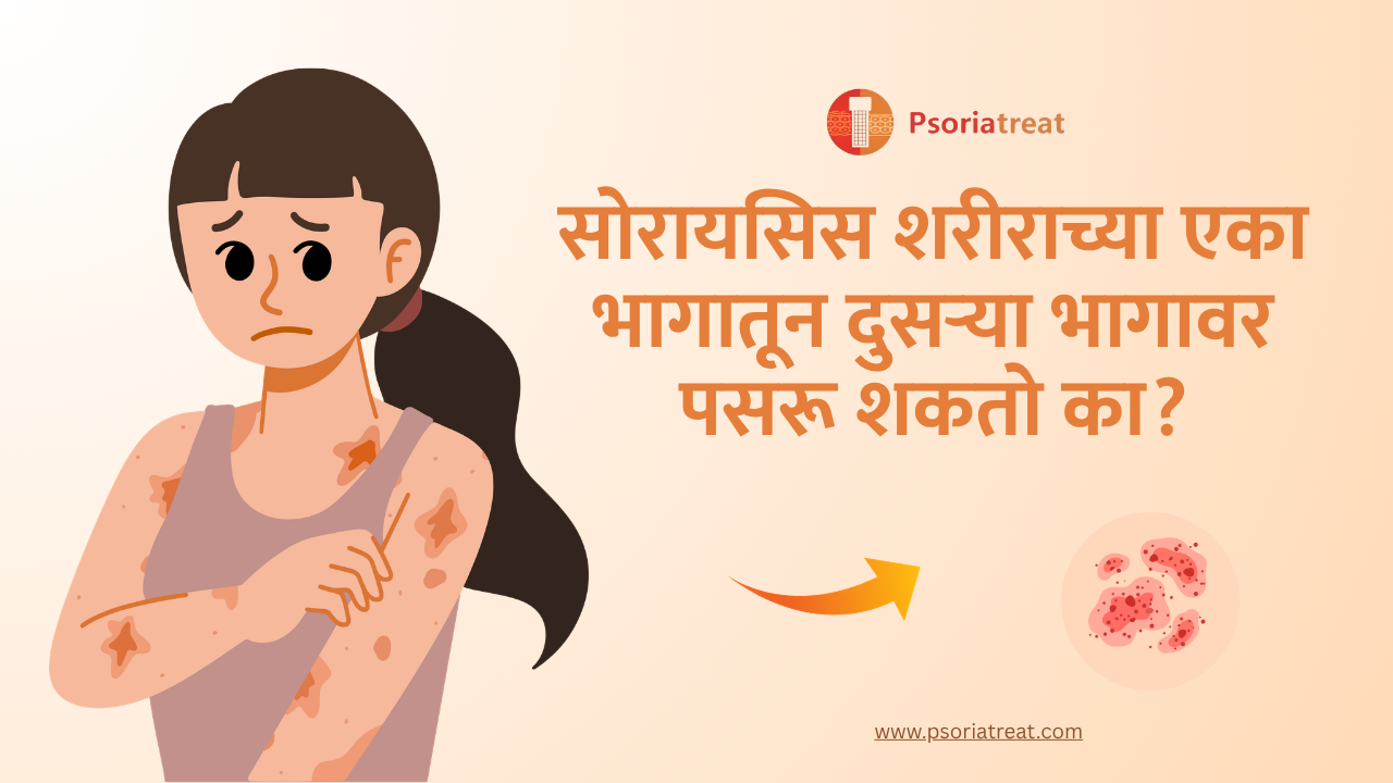 Can psoriasis spread from one body part to another in marathi