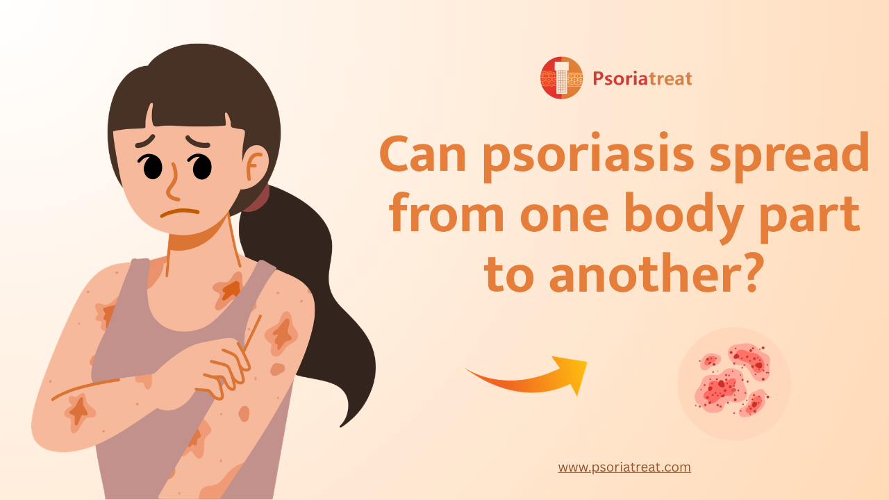 Can psoriasis spread from one body part to another?