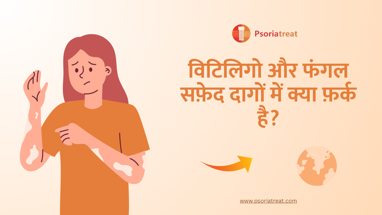How to tell the difference between vitiligo & fungal white patches in hindi