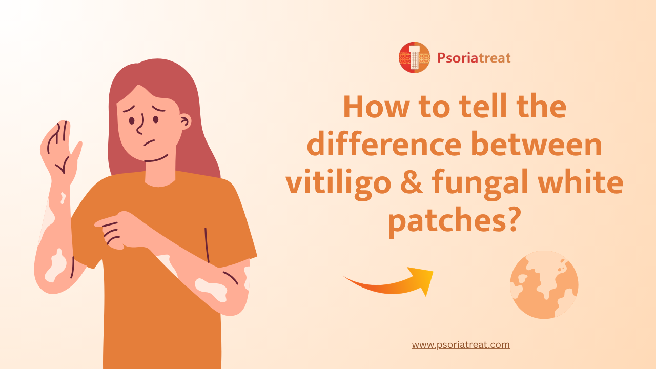 How to tell the difference between vitiligo & fungal white patches?