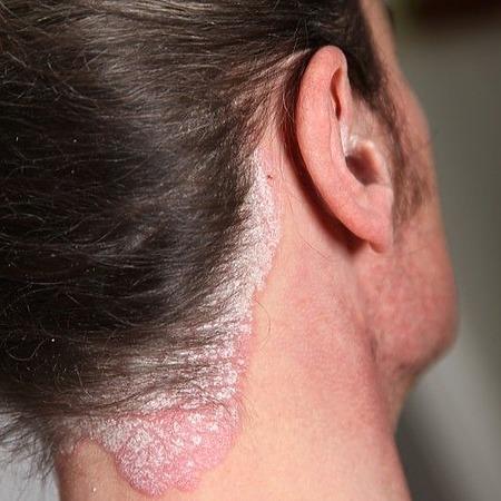 टाळूवरील सोरायसिसची लक्षणे: हा फक्त कोंडा नसू शकतो - Scalp Psoriasis Symptoms: When It May Not Be Dandruff in marathi 2