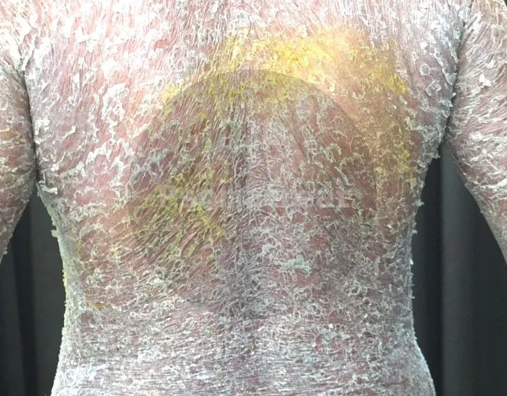 89 Erythrodermic Psoriasis