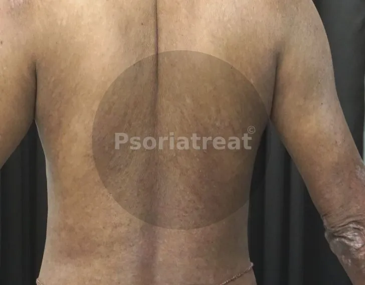 Erythrodermic Psoriasis