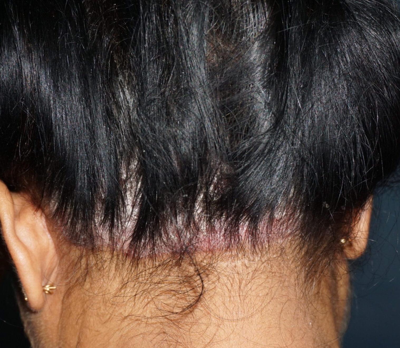 Scalp Psoriasis