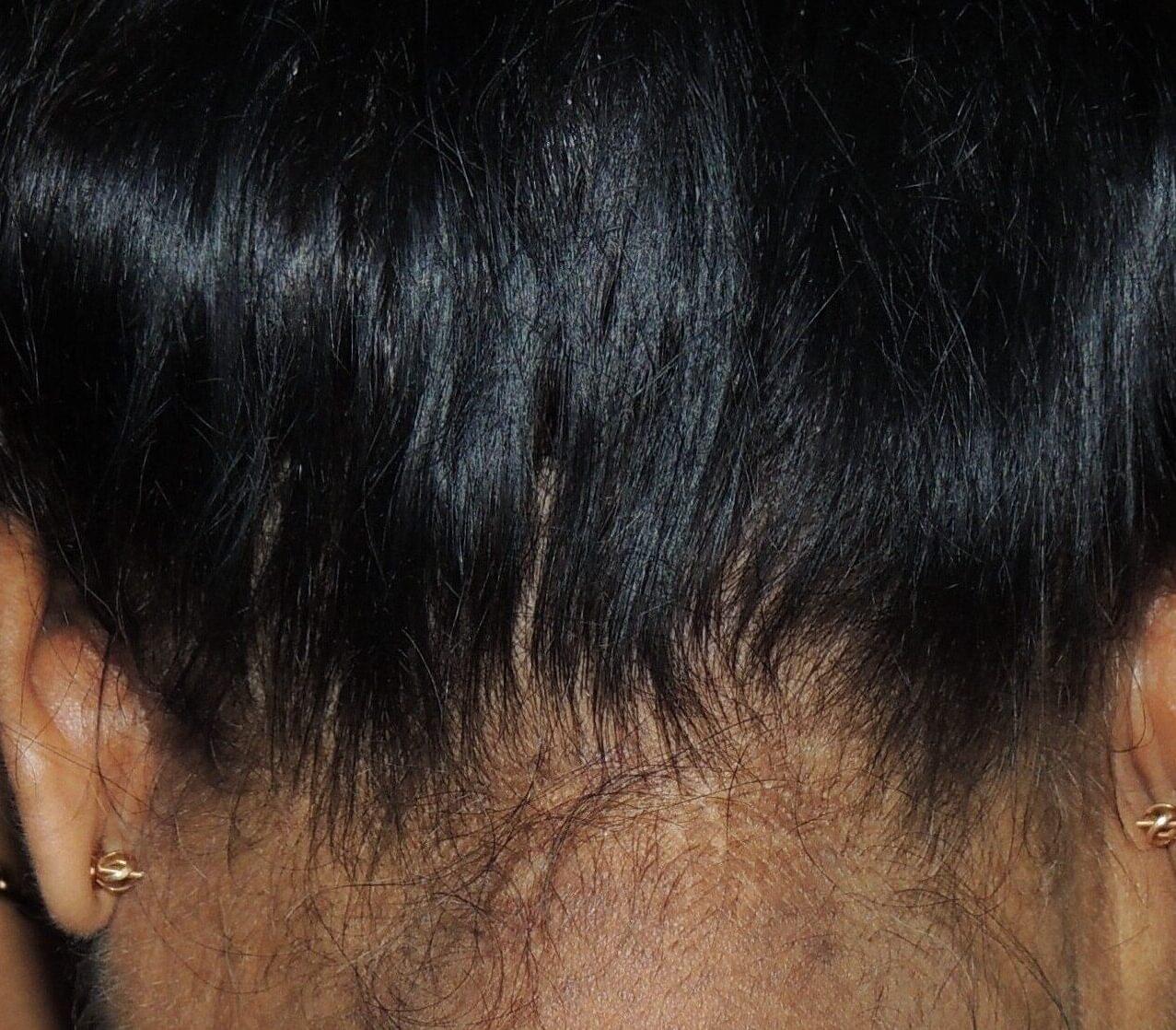 Scalp Psoriasis