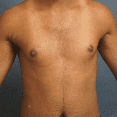 Erythrodermic Psoriasis - abdomen - After