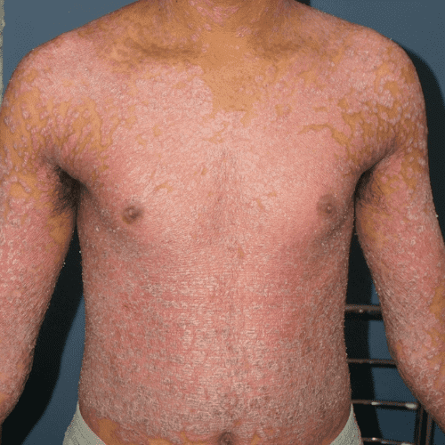 Erythrodermic Psoriasis - abdomen - Before