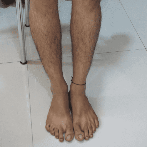 Guttate Psoriasis - Legs - After