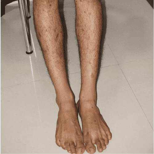 Guttate Psoriasis - Legs - Before