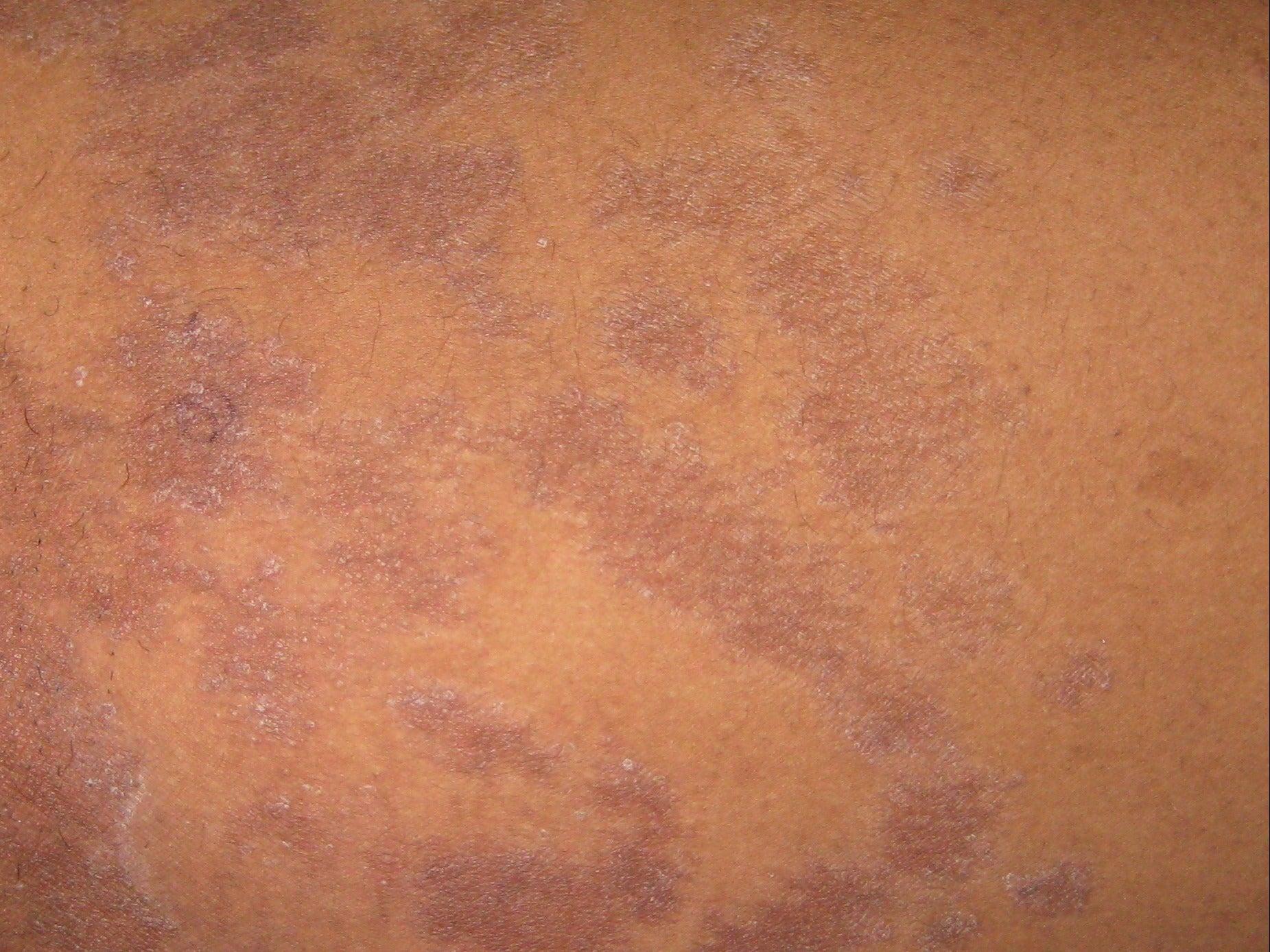 Why Does Skin Stay Dark or Light After Psoriasis Clears?  2