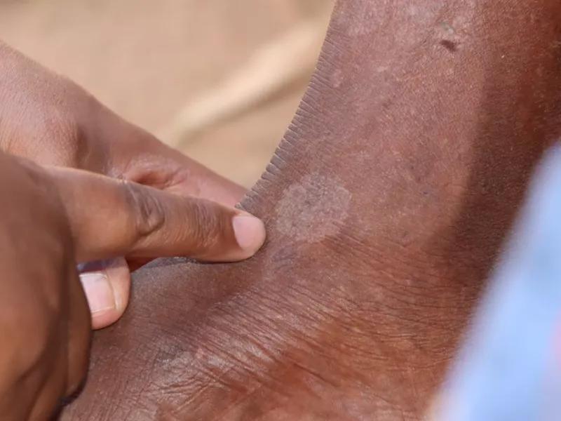 Why Does Skin Stay Dark or Light After Psoriasis Clears?  3
